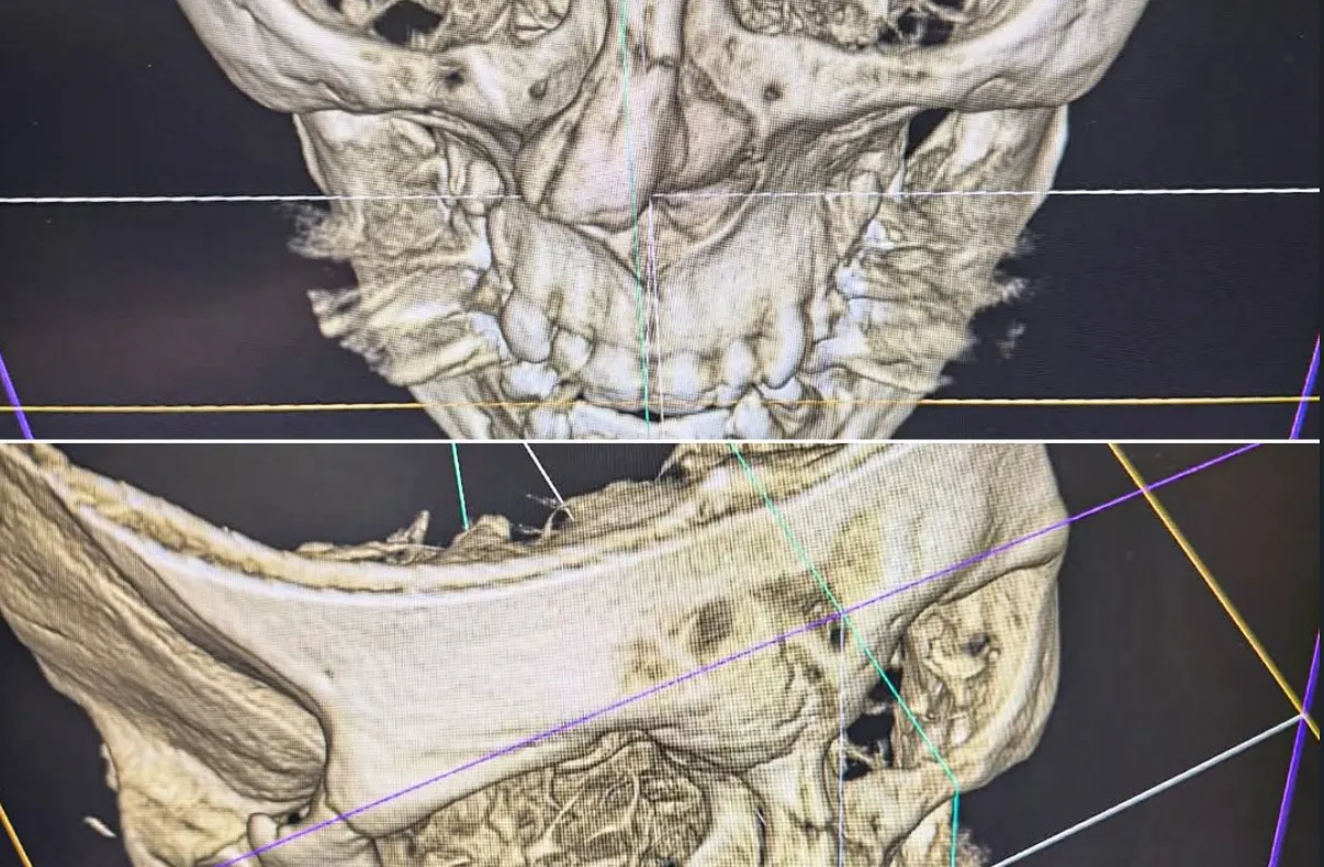 Merab Dvalishvili Refuses Surgery for Broken Nose to Avoid Year-Long Layoff - Merab Dvalishvili UFC News News